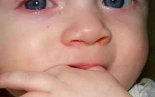 Почему гноится глаз у новорожденного