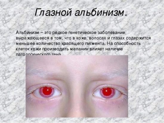 Глазной альбинизм