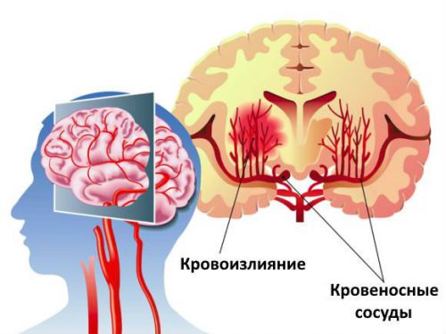 Инсульт