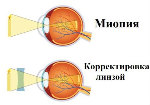 Миопия