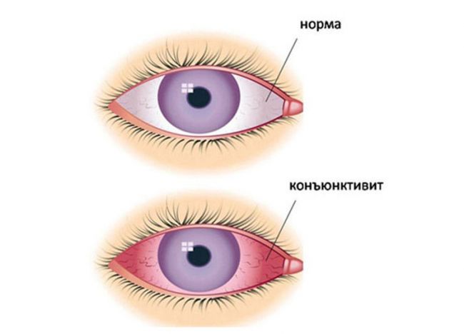 Конъюнктивит
