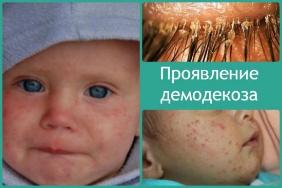 Демодекоз у ребенка