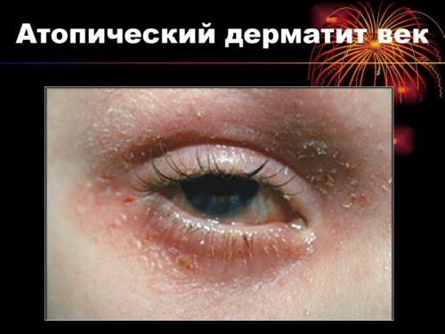 Атопический дерматит век