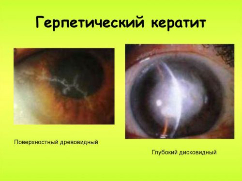 Герпетический кератит