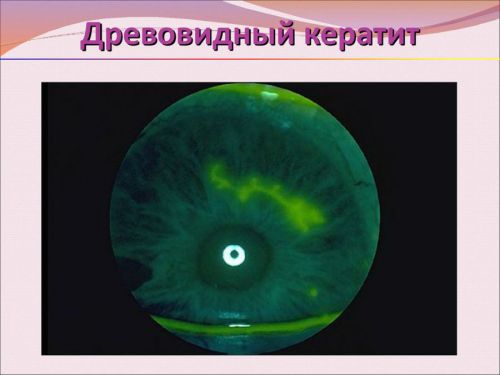 Древовидный кератит