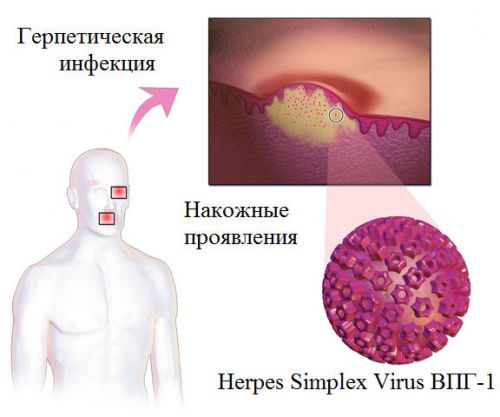 Герпетическая инфекция