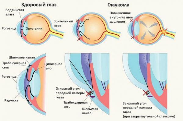 Виды глаукомы