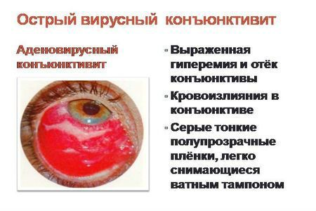 Острый вирусный конъюнктивит