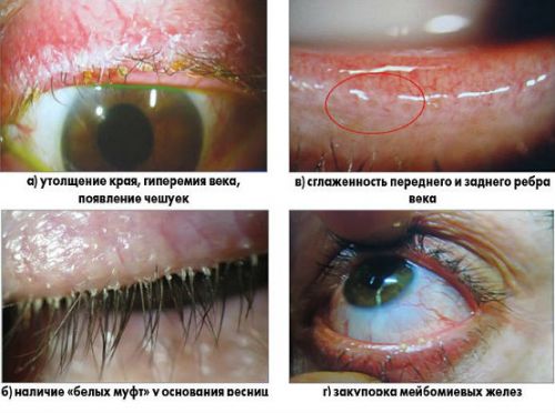 Симптомы блефарита