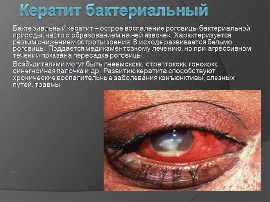 Бактериальный кератит
