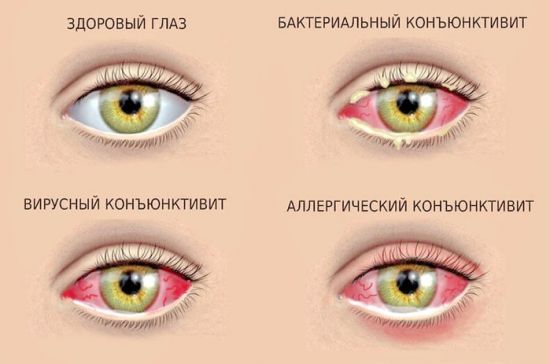 Конъюнктивит