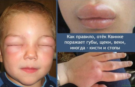 Отек Квинке на лице ребенка