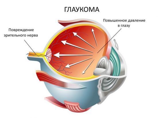Глаукома