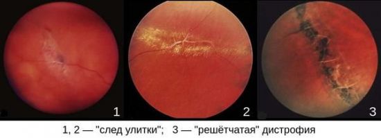 Дистрофия сетчатки