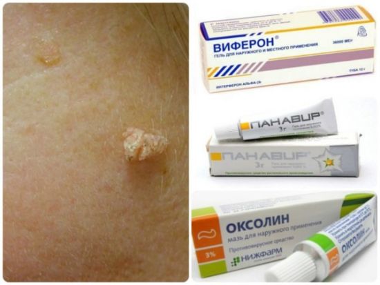 Аптечные средства от папиллом