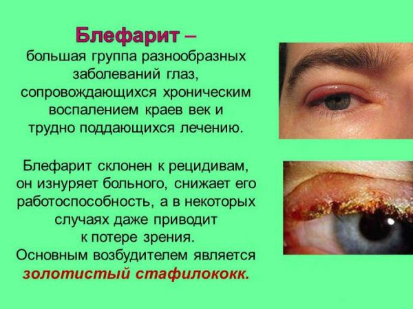 Блефарит