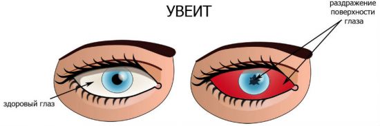 Увеит