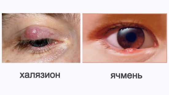 Халязион и ячмень