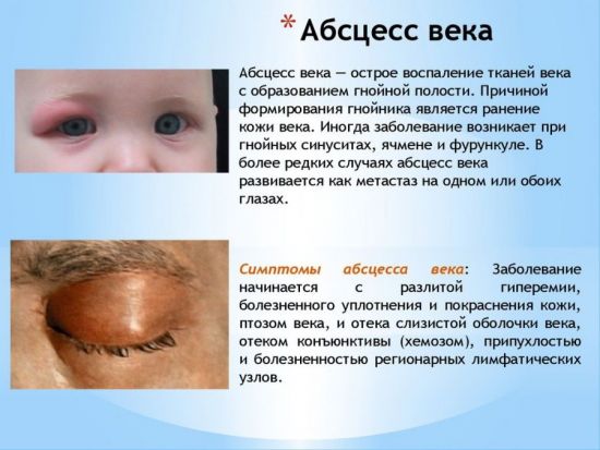 Абсцесс века 