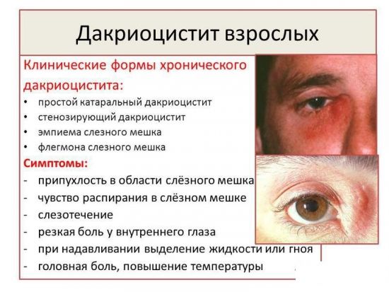Дакриоцистит