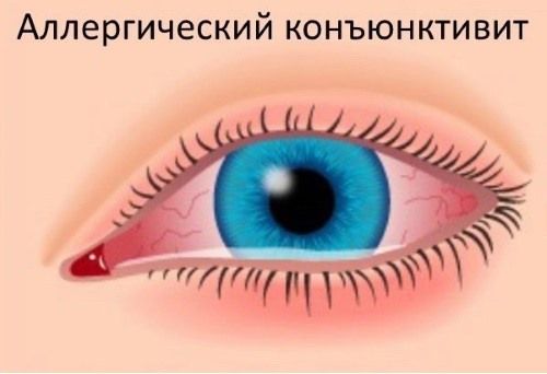Аллергический конъюнктивит