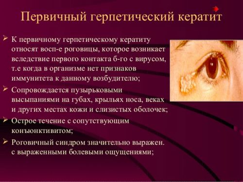 Герпетический кератит