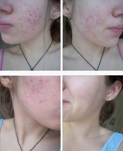 Результат ухода за кожей при прыщах