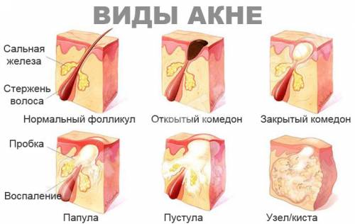 Виды прыщей