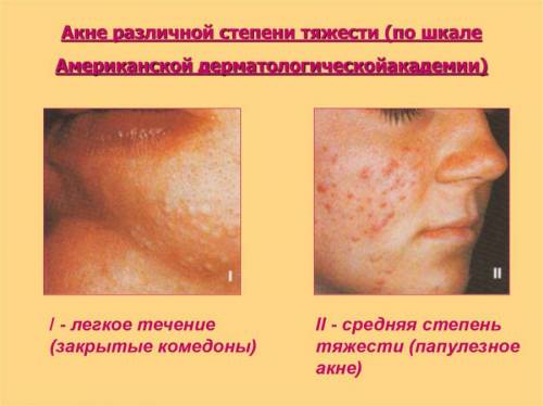 Разные стадии акне
