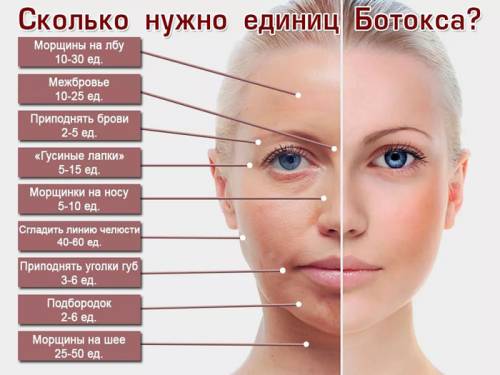 Количество ботокса на разные зоны лица