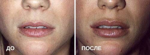 Губы до введения ботокса и после