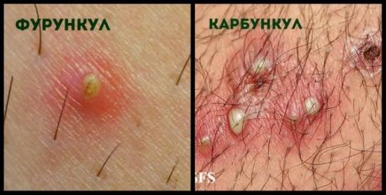 Фурункул и карбункул