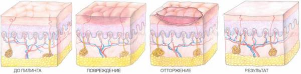 Результат пилинга