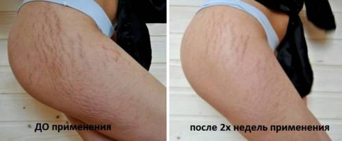 Растяжки на бедрах