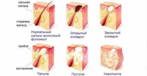 Виды прыщей