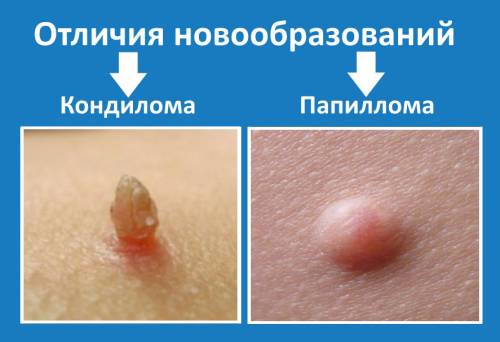 Кондилома и папиллома