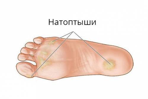 Натоптыши
