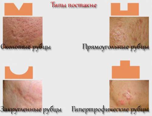 Типы рубцов от акне