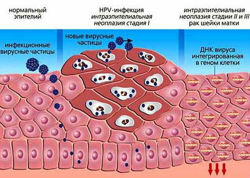 Развитие папилломы