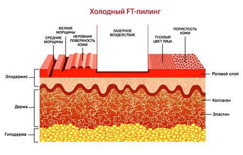 Холодный пилинг
