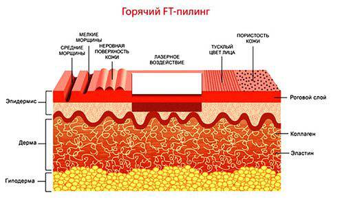 Горячий пилинг