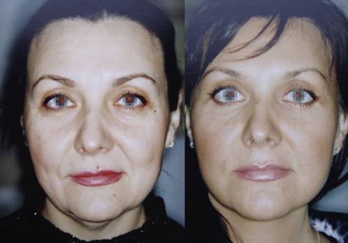 До омоложения лица и после
