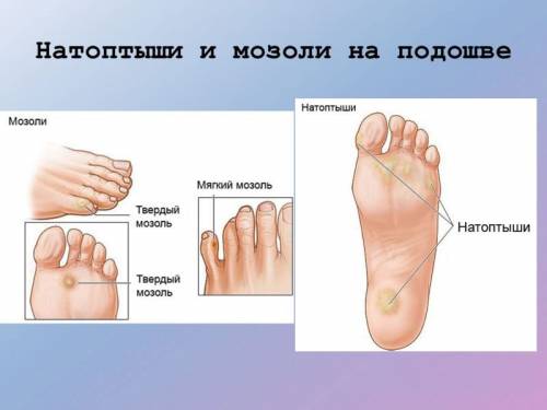 Мозоли и натоптыши