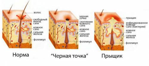 Норма, черная точка и прыщ