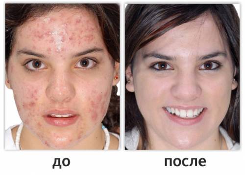 До лечения демодекоза и после