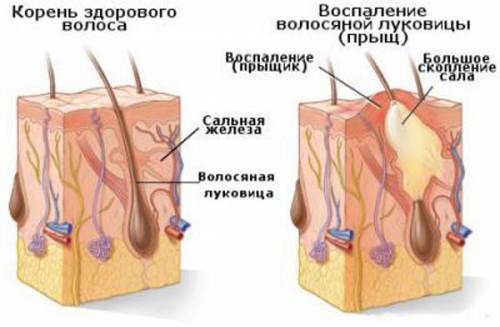 Воспаление волосяной луковицы