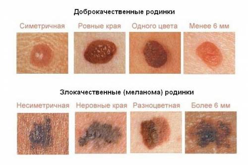 Доброкачественные образования