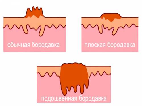 Виды подошвенных бородавок