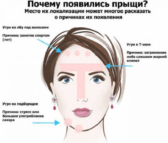 Причины прыщей в зависимости от локализации