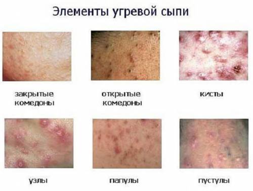 Элементы угревой стадии